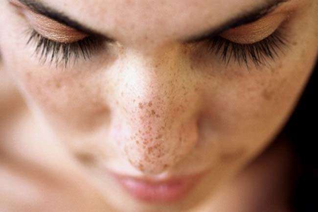 Tips To Get Rid Of Dark Spots on the Body – Best Herbal Products