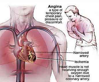 angina_pectoris